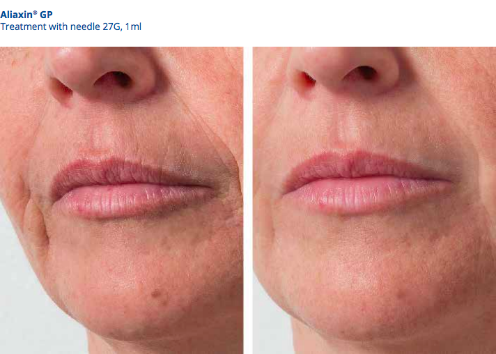 Aliaxin GP treatment Aliaxin GP treatment