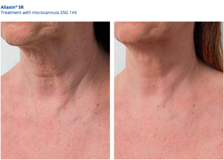 Aliaxin SR treatment Aliaxin SR treatment